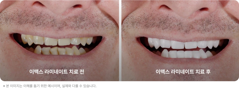 성북구 성모치과의원 이맥스 라미네이트 치료 전후 비교 예시 이미지