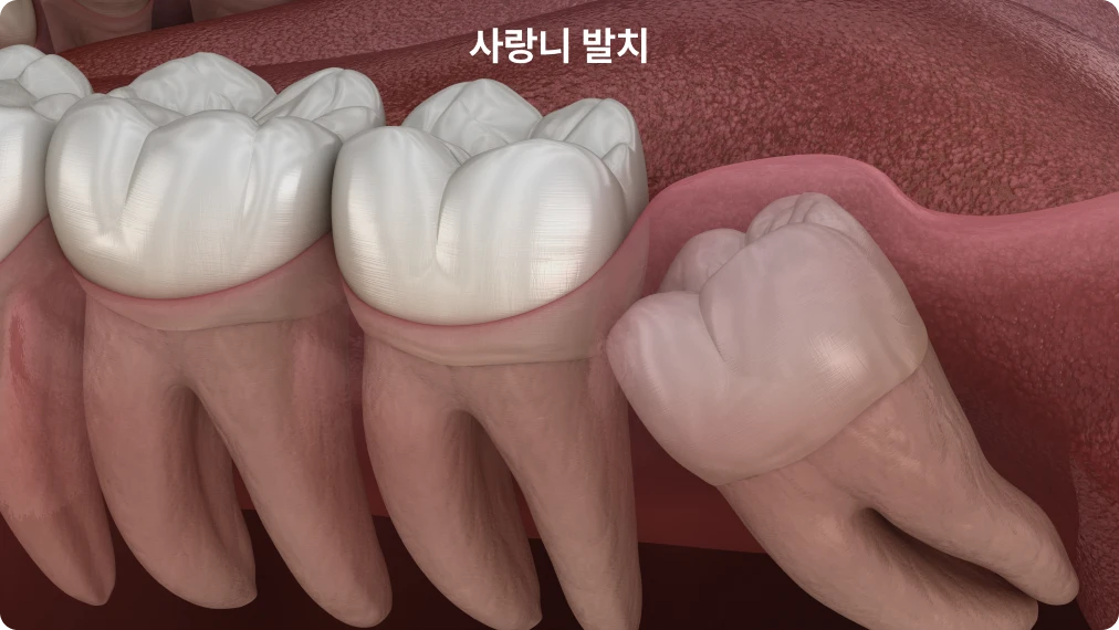 성북구 성모치과의원 잇몸치료·치주치료 이미지