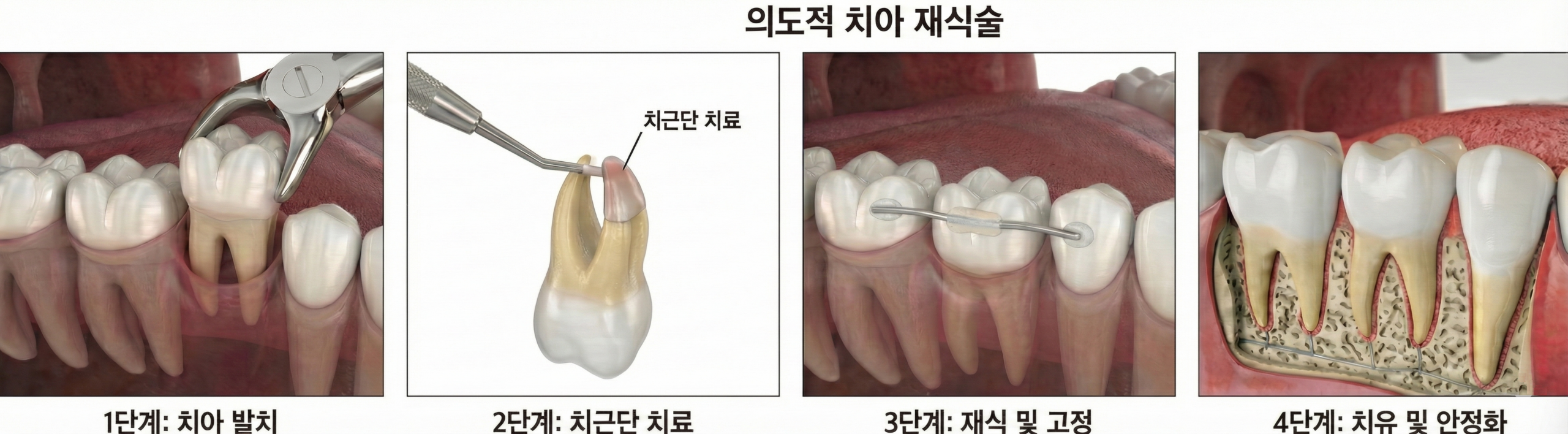 의도적 재식술