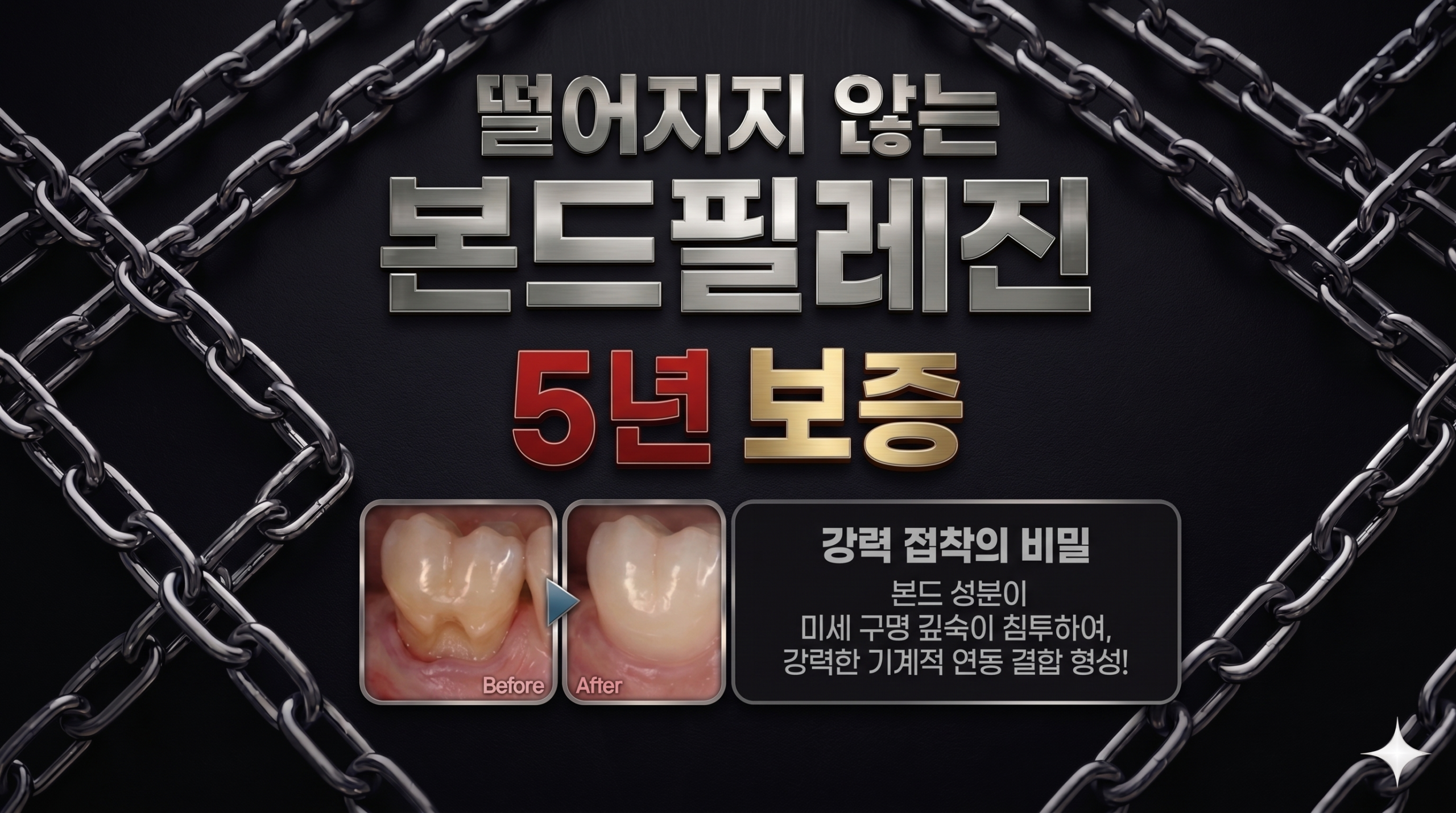 성북구 성모치과의원 본드필레진 — 치경부마모 교합면마모 레진 수복