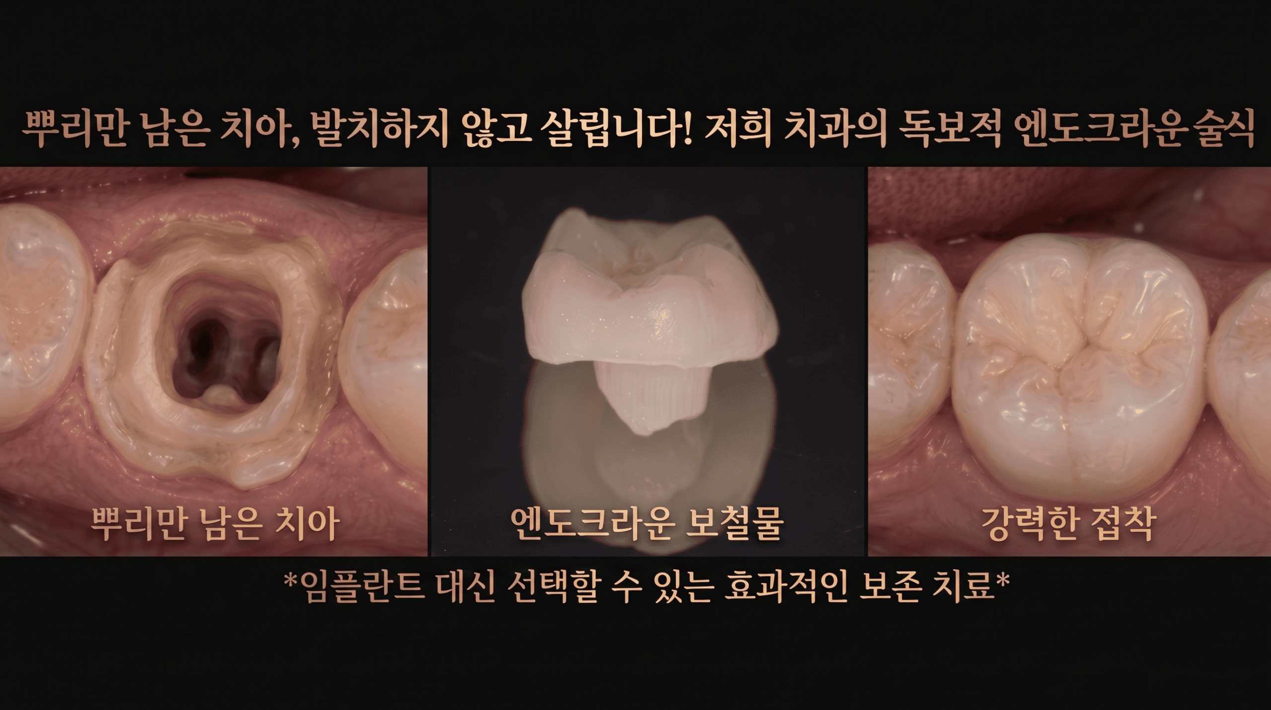 성모치과의원 엔도크라운 — 포스트 없이 세라믹 직접 결합 보철