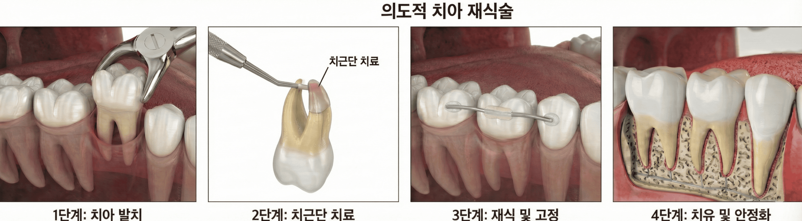 성신여대 성모치과의원 의도적 치아재식술 — 발치·구강외처치·재식·치유 4단계