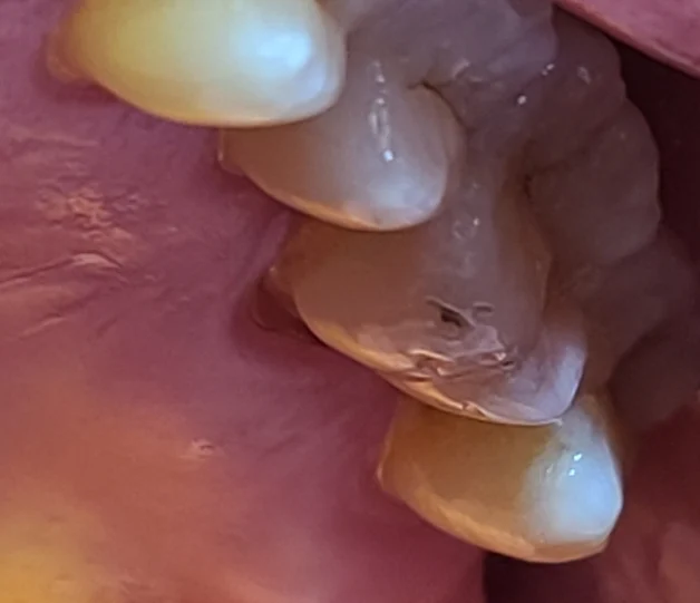 상악 첫 번째 큰어금니(#26번) 구개측 치경부가 깊게 패인 치료 전 구강 내 사진, 앞뒤 치아는 온전한 상태