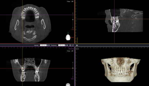 치근단절제술 MTA 역충전 후 밀봉 상태를 확인한 CBCT 영상