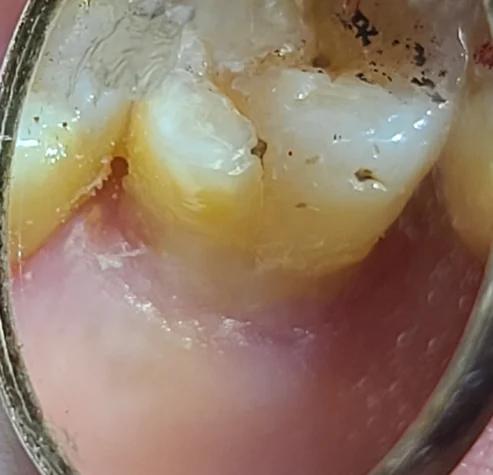 본드필 재료로 치경부 패인 부위 수복을 마친 구강 내 사진