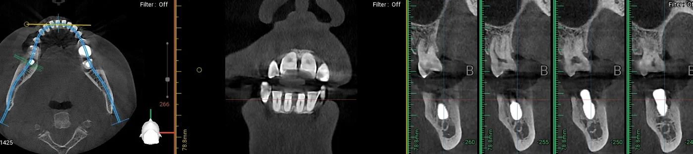 아래턱 3D CT 단면 화면 — 가로 단면, 앞 단면, 어금니 자리 세로 단면 4컷 (일부 발췌)