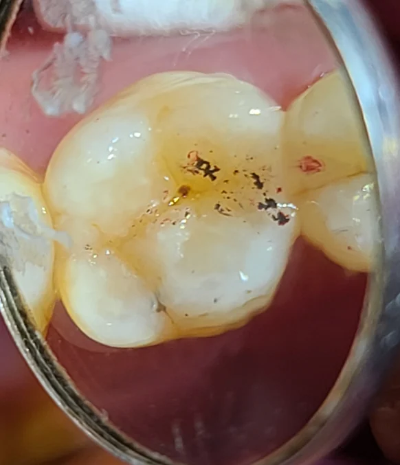 교합조정 후 다시 교합지로 확인한 사진, 교합점이 여러 치아에 고르게 분산된 모습