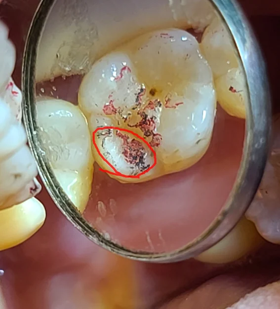 교합지로 물린 상태를 확인한 검사 사진, MP 교두에 교합점이 집중되고 측방력 표시가 확인됨