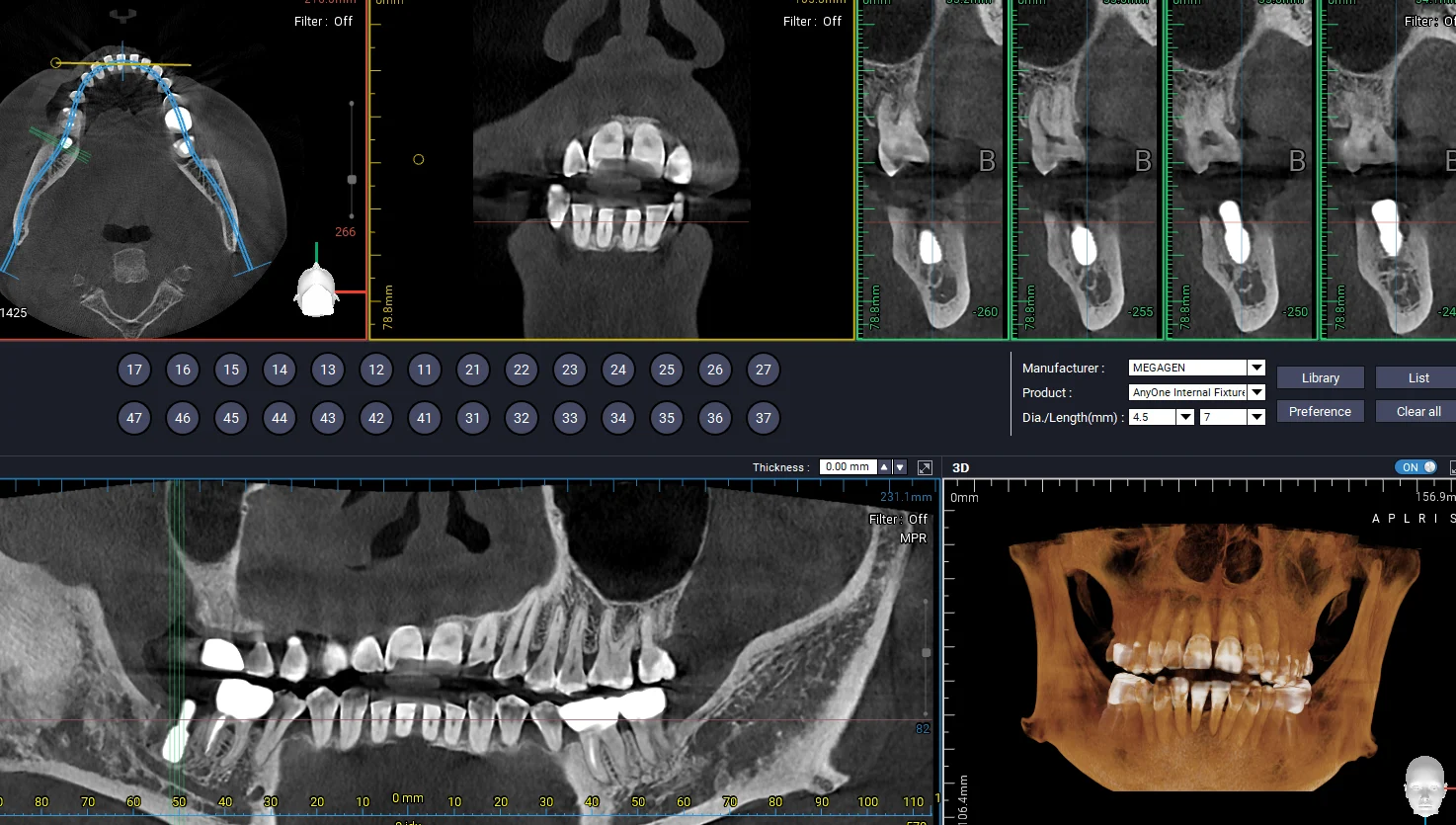 3D CT 기반 가상 수술 계획과 하치조신경관 근접 임플란트 즉시식립 관련 사진