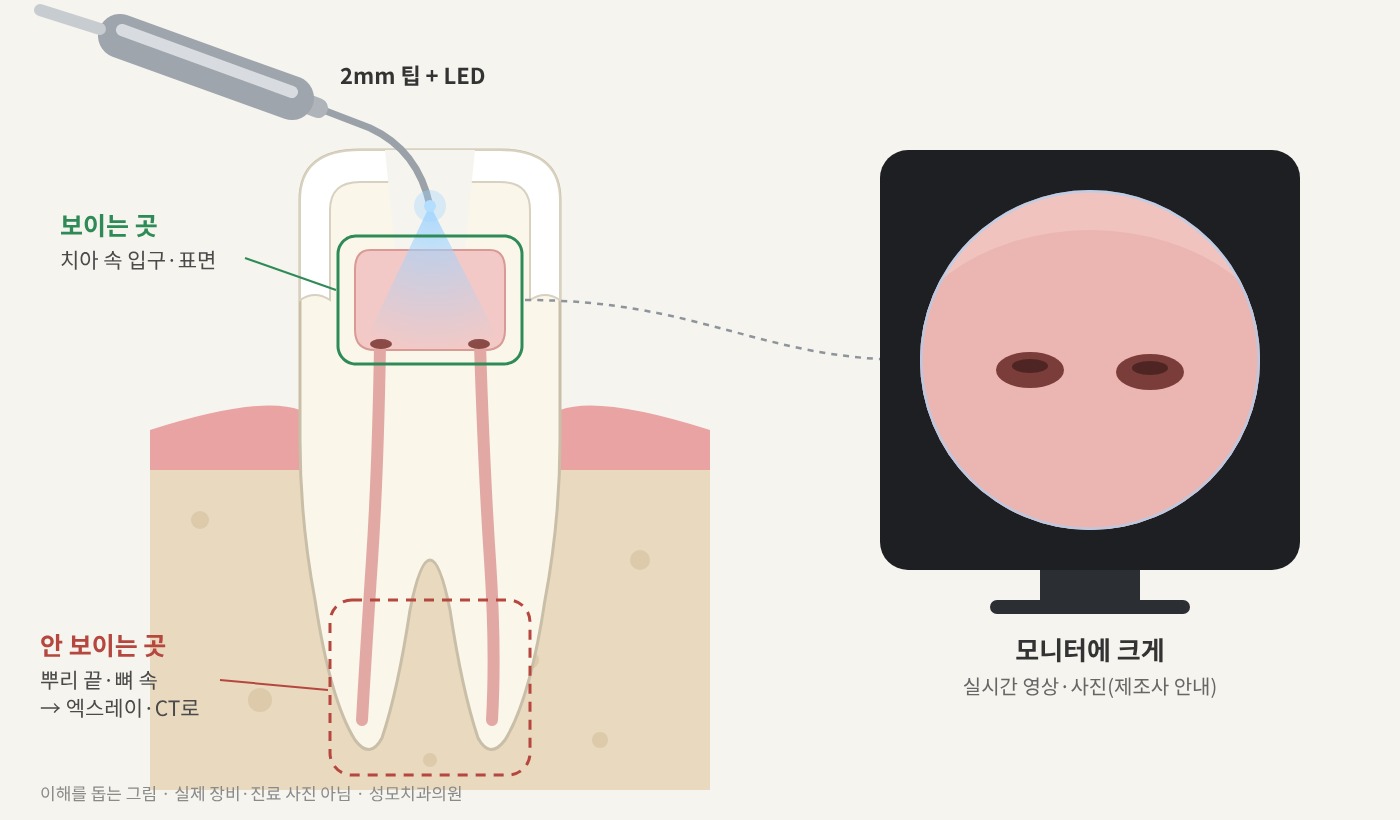 구강 카메라 2mm 팁으로 보이는 곳(치아 속 입구·표면)과 보이지 않는 곳(뿌리 끝·뼈 속)을 나타낸 그림