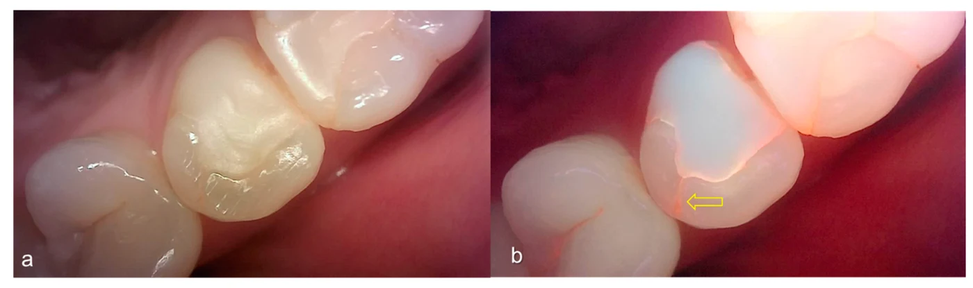 The same premolar photographed under white light and with quantitative light-induced fluorescence — the crack appears as a red line on the fluorescence image (figure from the published literature)